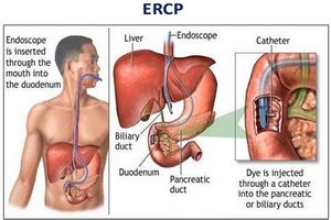 ERCP-Endoscopic Retrograde Cholangiopancreatography