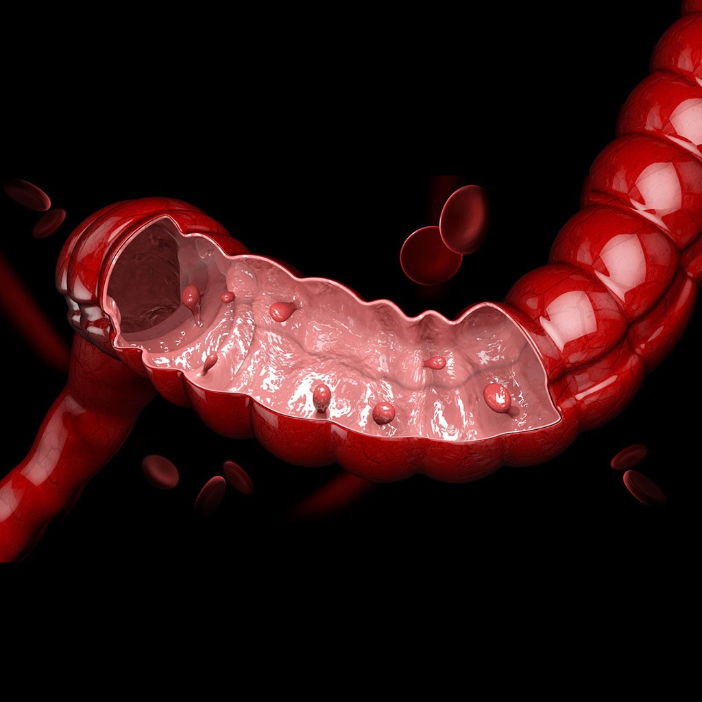 Colorectal Polyps